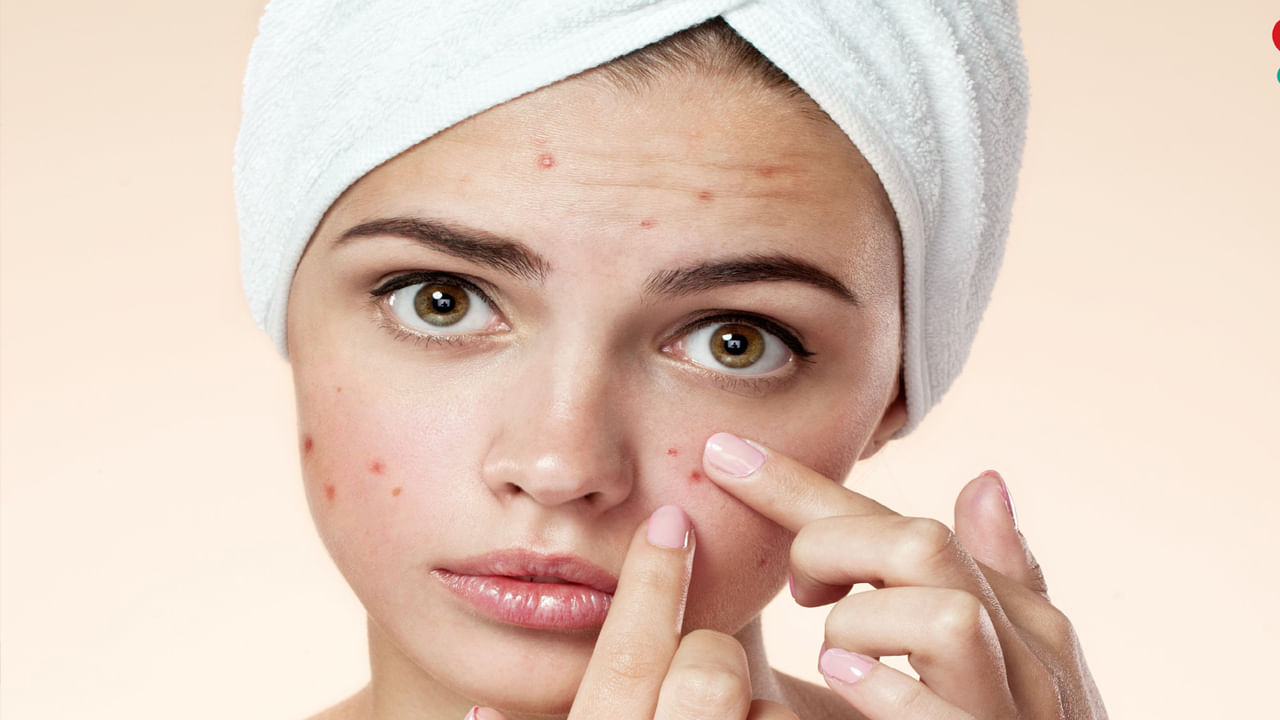 Skin care tips: చర్మ సంరక్షణ.. మొటిమల నివారణ కోసం ఏం చేయాలంటే..?