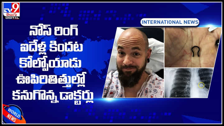 Nose ring: నోస్ రింగ్ ఐదేళ్ల కిందట కోల్పోయాడు.. ఊపిరితిత్తుల్లో కనుగొన్న డాక్టర్లు.. స్కానింగ్ లో మరో షాక్.. Nose ring: నోస్ రింగ్ ఐదేళ్ల కిందట కోల్పోయాడు.. ఊపిరితిత్తుల్లో కనుగొన్న డాక్టర్లు.. స్కానింగ్ లో మరో షాక్..