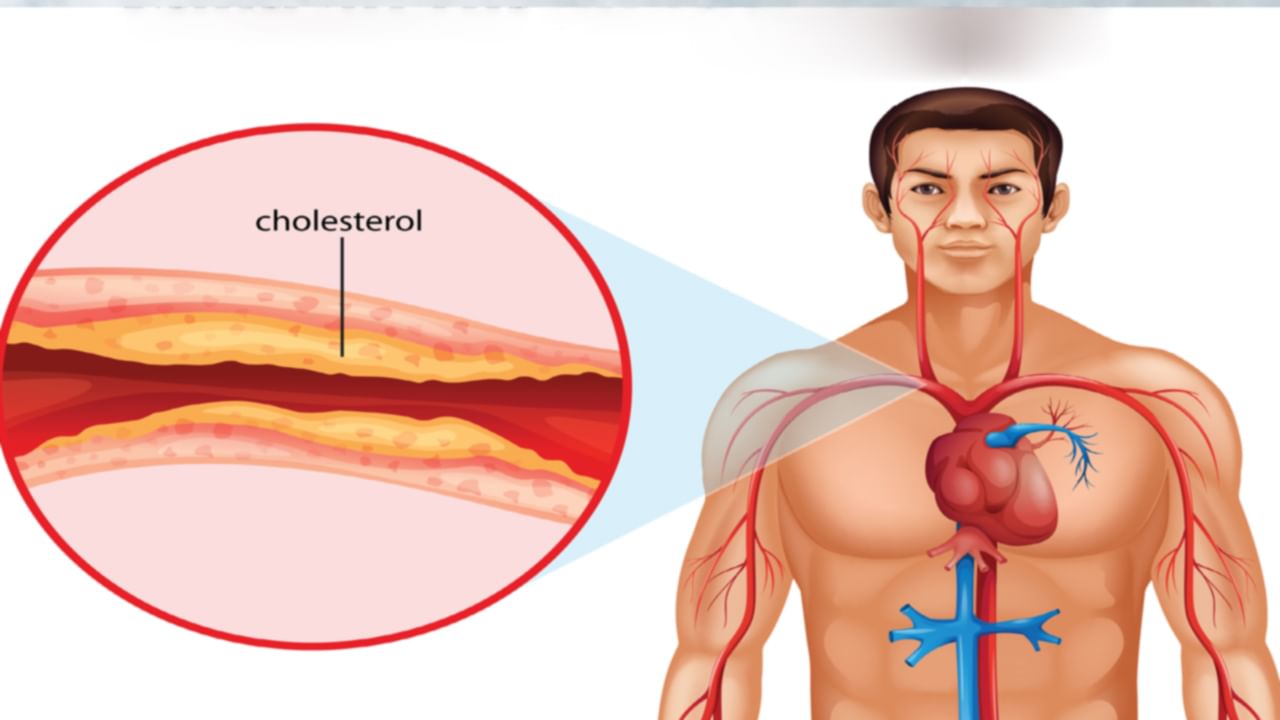 Cholesterol: కొలెస్ట్రాల్ స్థాయి 200 కంటే ఎక్కువ గుండె జబ్బుల ప్రమాదాన్ని పెంచుతుంది.. కొలెస్ట్రాల్‌ను తగ్గించే చిట్కాలు ఇవే..