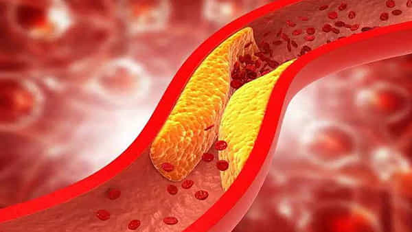 Cholesterol: మీ శరీరంలో ఈ 4 ప్రమాదకరమైన లక్షణాలు కనిపిస్తున్నాయా? అది దాని ఎఫెక్టే.. బీ అలర్ట్..