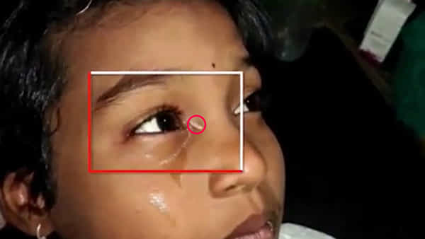 Telangana News: ఇదేం వింత.. బాలిక కంటి నుంచి కన్నీళ్లతో పాటు బియ్యం, రాళ్లు..