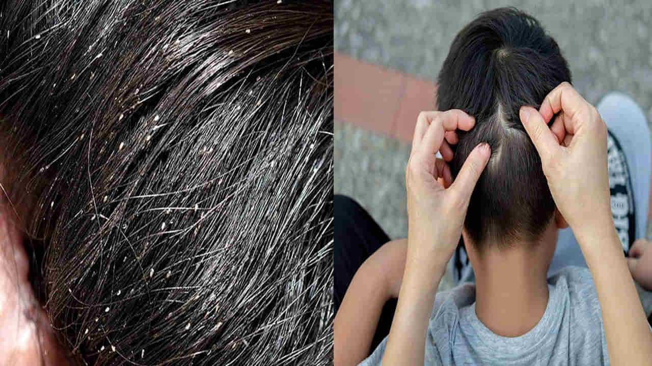 Head lice: పేలు ఎన్ని సంవత్సరాల క్రితం పుట్టాయో తెలుసా..? ఏటా 1.20 కోట్ల మంది బాధితులు.. ఇంట్రెస్టింగ్ ఫ్యాక్ట్స్ మీకోసం