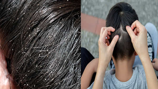 Head lice: పేలు ఎన్ని సంవత్సరాల క్రితం పుట్టాయో తెలుసా..? ఏటా 1.20 కోట్ల మంది బాధితులు.. ఇంట్రెస్టింగ్ ఫ్యాక్ట్స్ మీకోసం