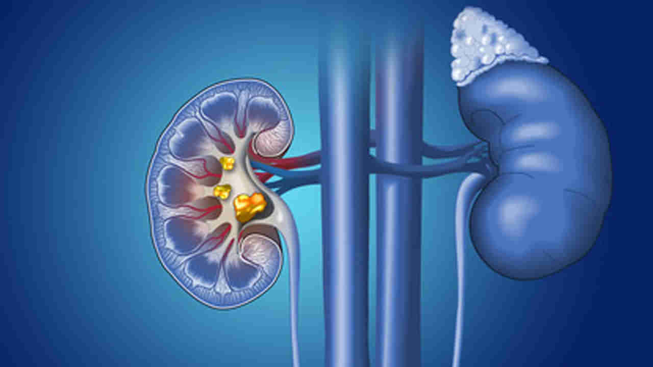 Kidney Stone Signs:ఈ నాలుగు సంకేతాలు శరీరంలో రాళ్లను సూచిస్తాయి.. నిర్లక్ష్యం చేస్తే మొదటికే మోసం.. జర భద్రం!