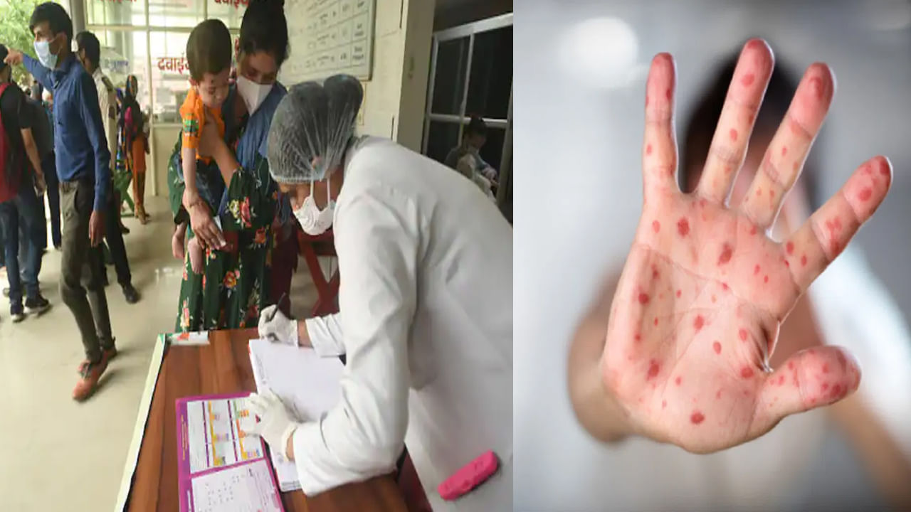 Measles Outbreak: ముంబైలో చిన్నారుల ప్రాణాలను హరిస్తున్న మీజిల్స్.. రంగంలోకి ఉన్నతస్థాయి కేంద్ర బృందాలు..