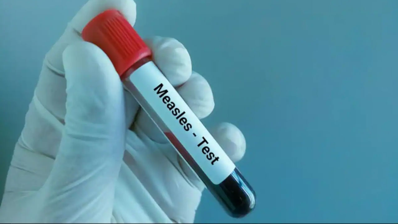 Measles: 'తట్టు' కోలేకపోతోన్న ముంబై మహానగరం.. మీజిల్స్‌తో 11 మంది మృత్యువాత.. భారీగా పెరుగుతున్న కేసులు