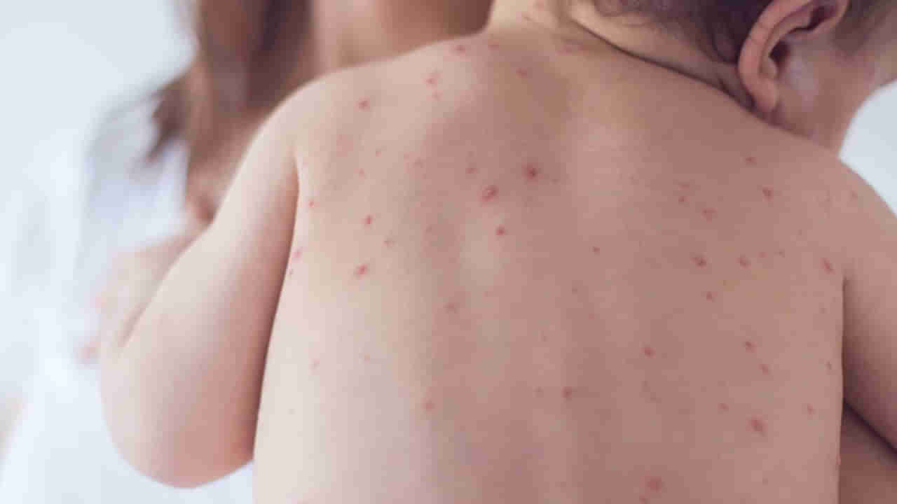 Measles: చిన్నారుల్లో మీజిల్స్‌ ముప్పు.. ప్రపంచవ్యాప్తంగా భారీగా వ్యాప్తి చెందే అవకాశం ఉందంటోన్న నిపుణులు..