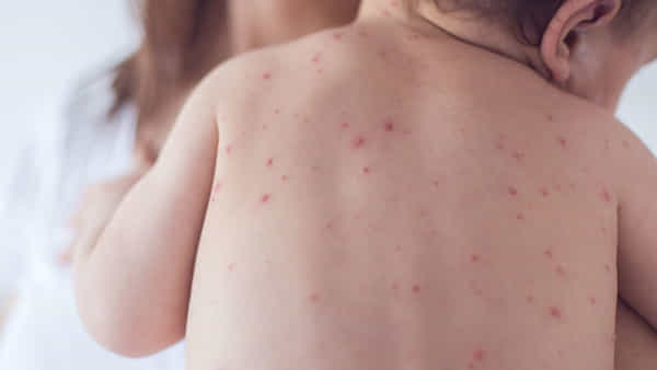 Measles: చిన్నారుల్లో మీజిల్స్ ముప్పు.. ప్రపంచవ్యాప్తంగా భారీగా వ్యాప్తి చెందే అవకాశం ఉందంటోన్న నిపుణులు..