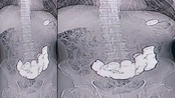 Viral: కడుపునొప్పితో అస్పత్రికి తీసుకెళ్లగా.. ఎక్స్రే చూసి డాక్టర్లు షాక్.. ఒకటి కాదు రెండు కాదు ఏకంగా..