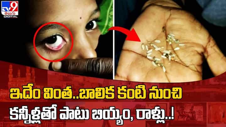 ఇదేం వింత.. బాలిక కంటి నుంచి కన్నీళ్లతో పాటు బియ్యం, రాళ్లు ఇదేం వింత.. బాలిక కంటి నుంచి కన్నీళ్లతో పాటు బియ్యం, రాళ్లు