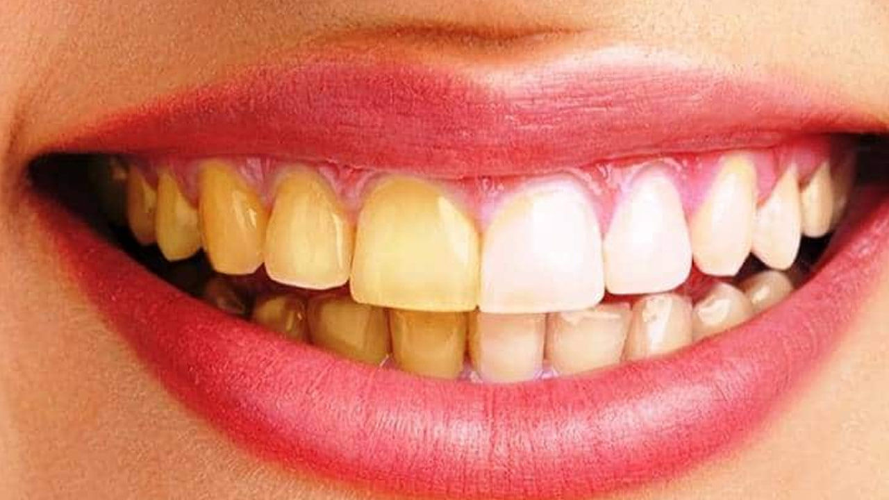 Whiten Teeth: దంతాలు ముత్యాల్లా మెరవాలనుకుంటున్నారా..? అయితే, ఈ పొడి ట్రై చేయండి.. జస్ట్ వారంలోనే..