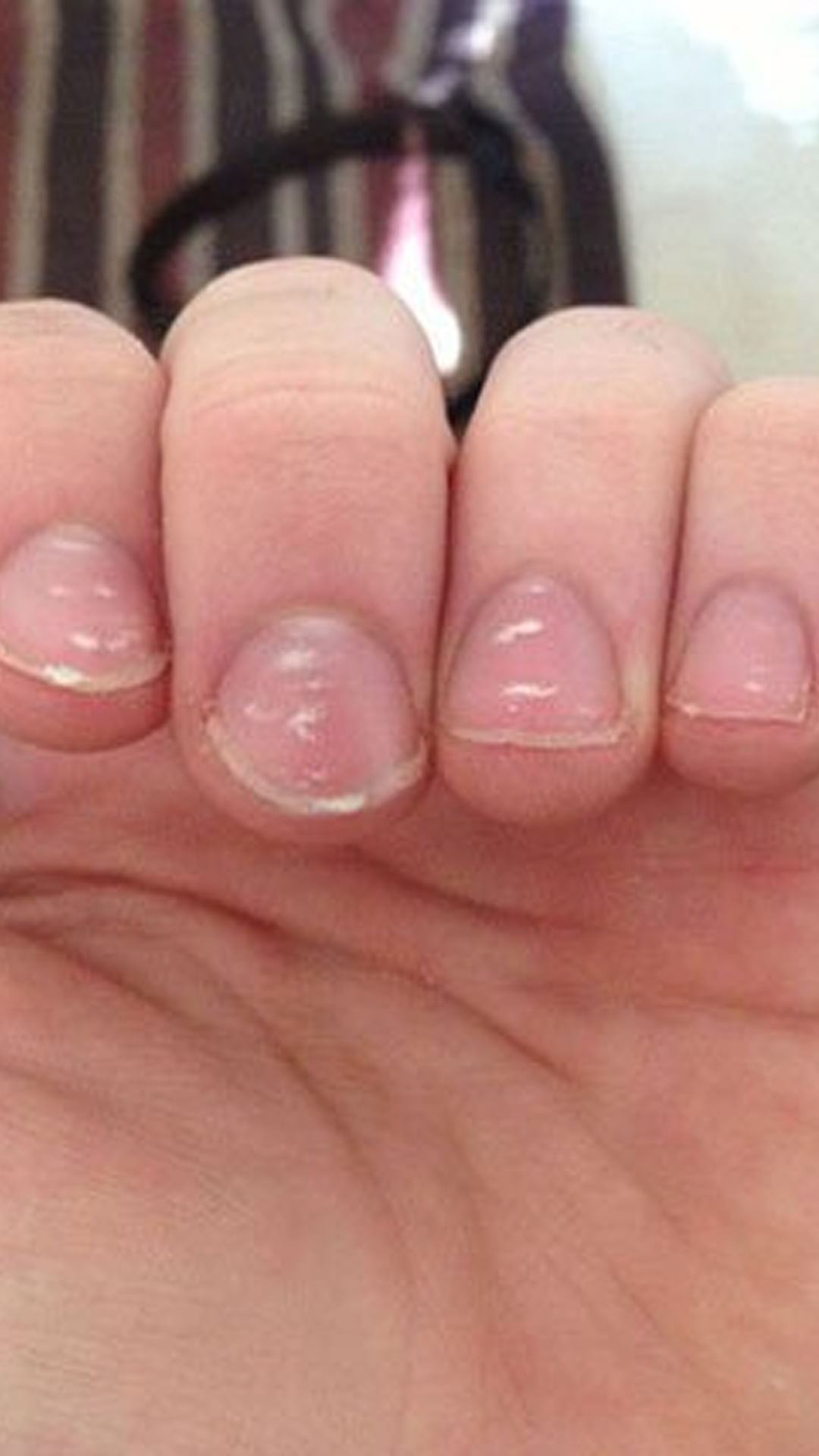 White Spots On Your Child's Nail – Should You Be Worried?