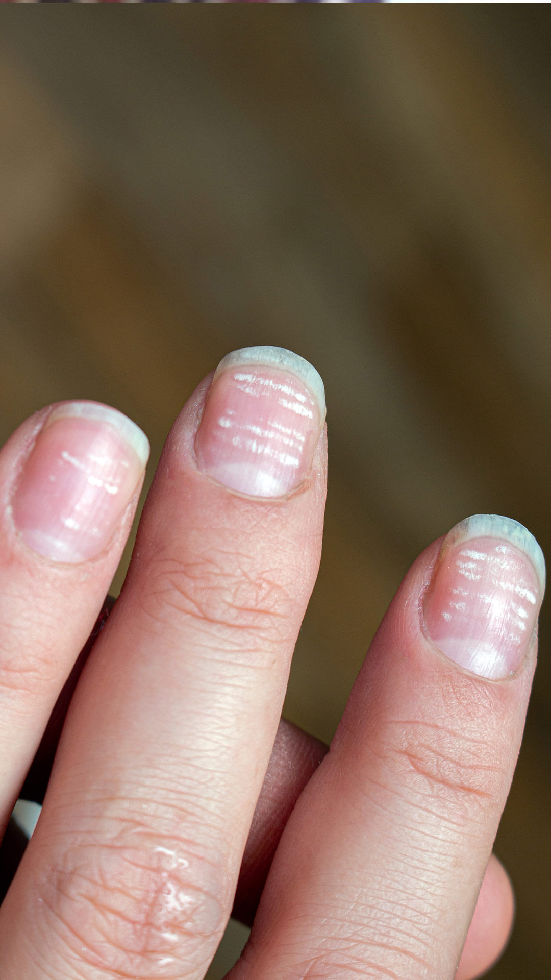 Banish white spots on nails - Shop Nailner Nail Fungus Treatment.