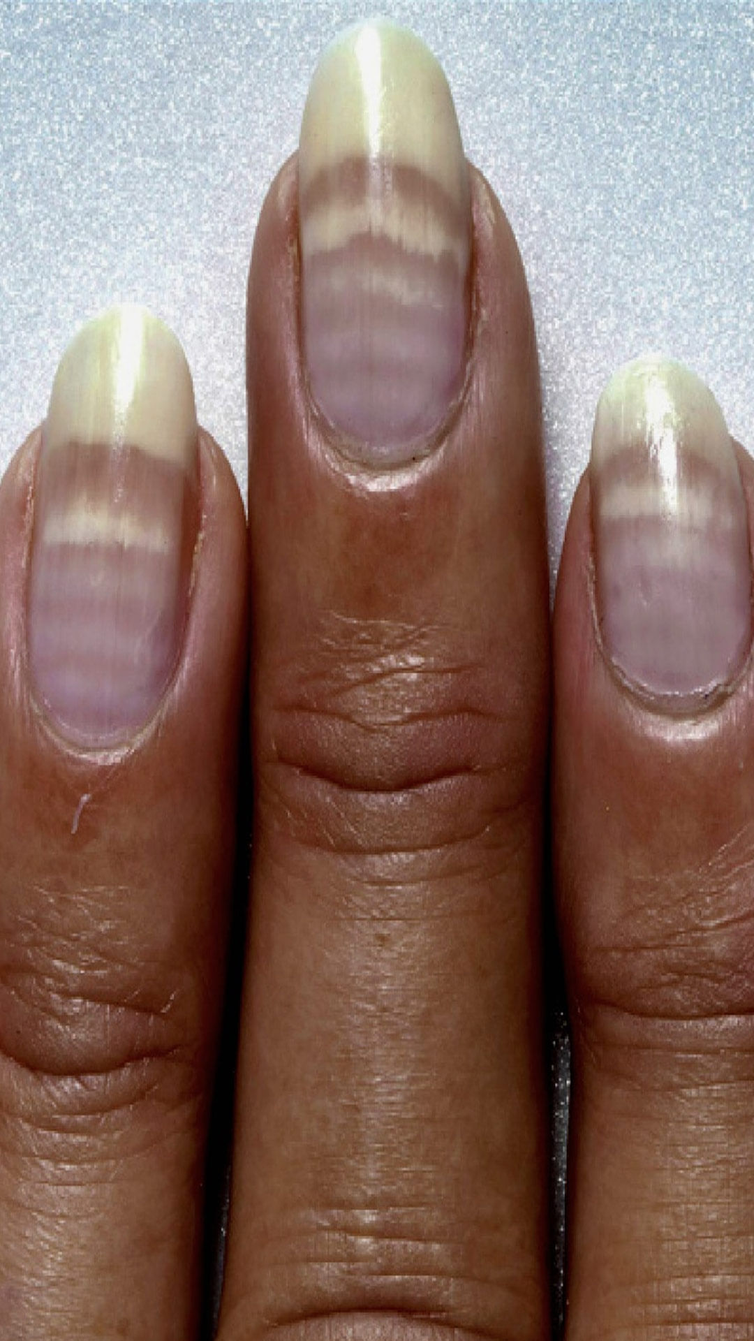 Iron Deficiency 5 Early Indications to Identify Iron Insufficiency on Skin  Hair And Nails