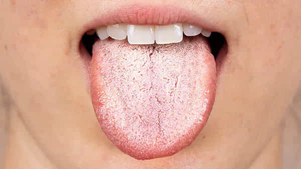 White Tongue: నాలుక తెల్లగా కనిపిస్తోందా? తస్మాత్ జాగ్రత్త.. ఆ జబ్బులకు సంకేతం కావొచ్చు