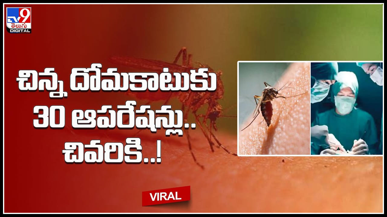 Mosquito bite effect: చిన్న దోమకాటుకు 30 ఆపరేషన్లు.. చివరికి కోమాలోకి ...