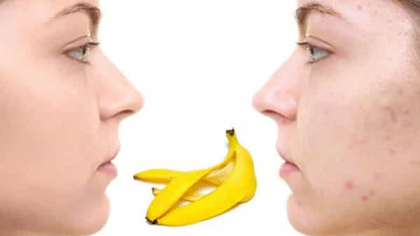 Banana Peel Uses: తొక్కే కదా అని తీసిపారేయకండి.. అనేక చర్మ సమస్యలకు ఇది అద్భుత పరిష్కారం!