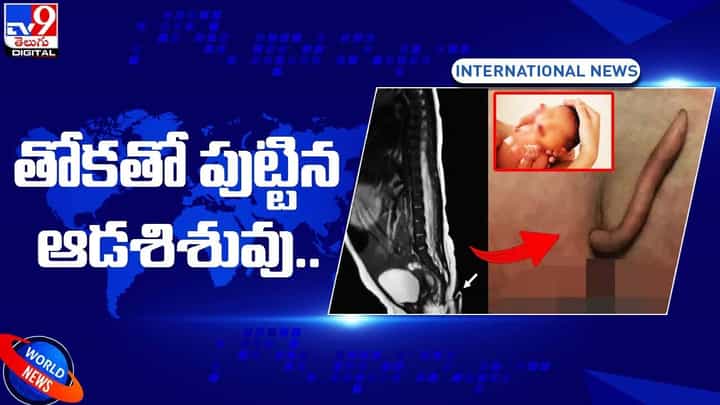 తోకతో పుట్టిన ఆడశిశువు.. అరుదుగా 'ట్రూ టెయిల్స్' శిశువుల జననం.. తోకతో పుట్టిన ఆడశిశువు.. అరుదుగా 'ట్రూ టెయిల్స్' శిశువుల జననం..