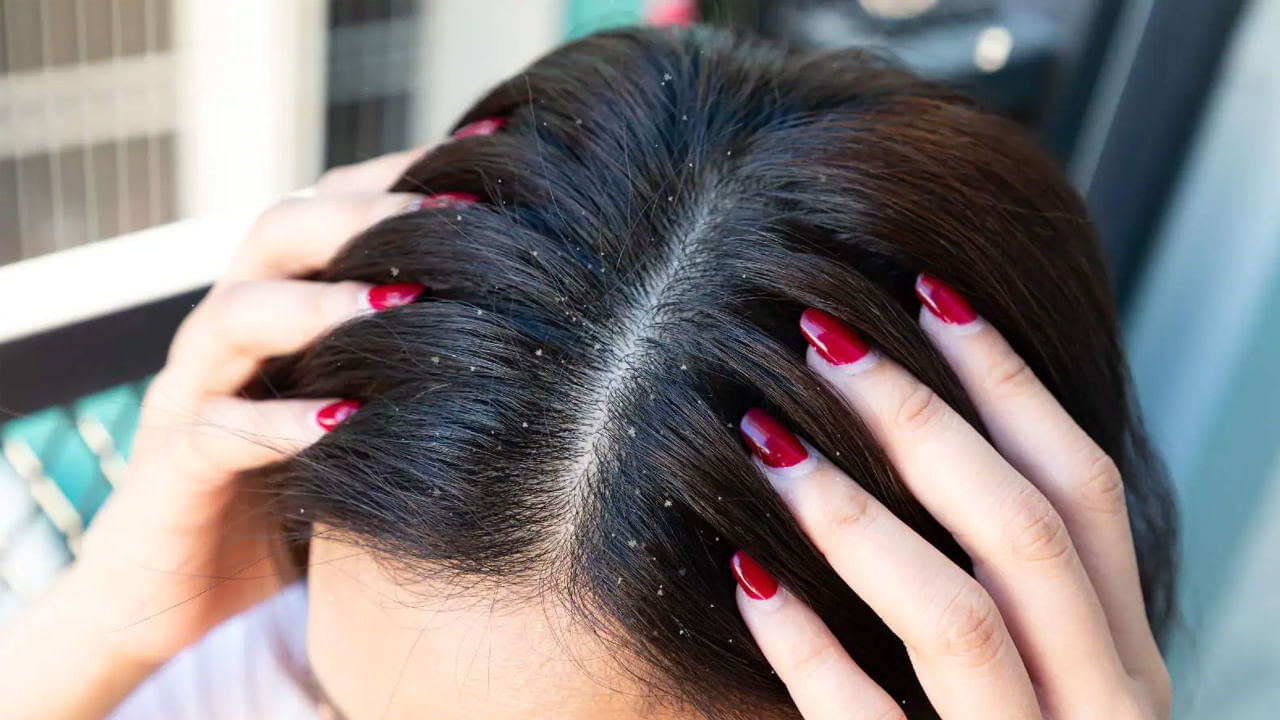 Dandruff Tips: చలికాలం చుండ్రు సమస్య వేధిస్తోందా.? ఈ చిట్కాలు పాటిస్తే వెంటనే ఫలితం..