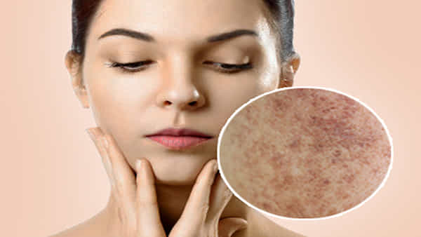 Dark spots on face: డార్క్ స్పాట్స్తో ఇబ్బంది పడుతున్నారా..? కారణాలు.. నివారణ చర్యలు తెలుసుకోండి...