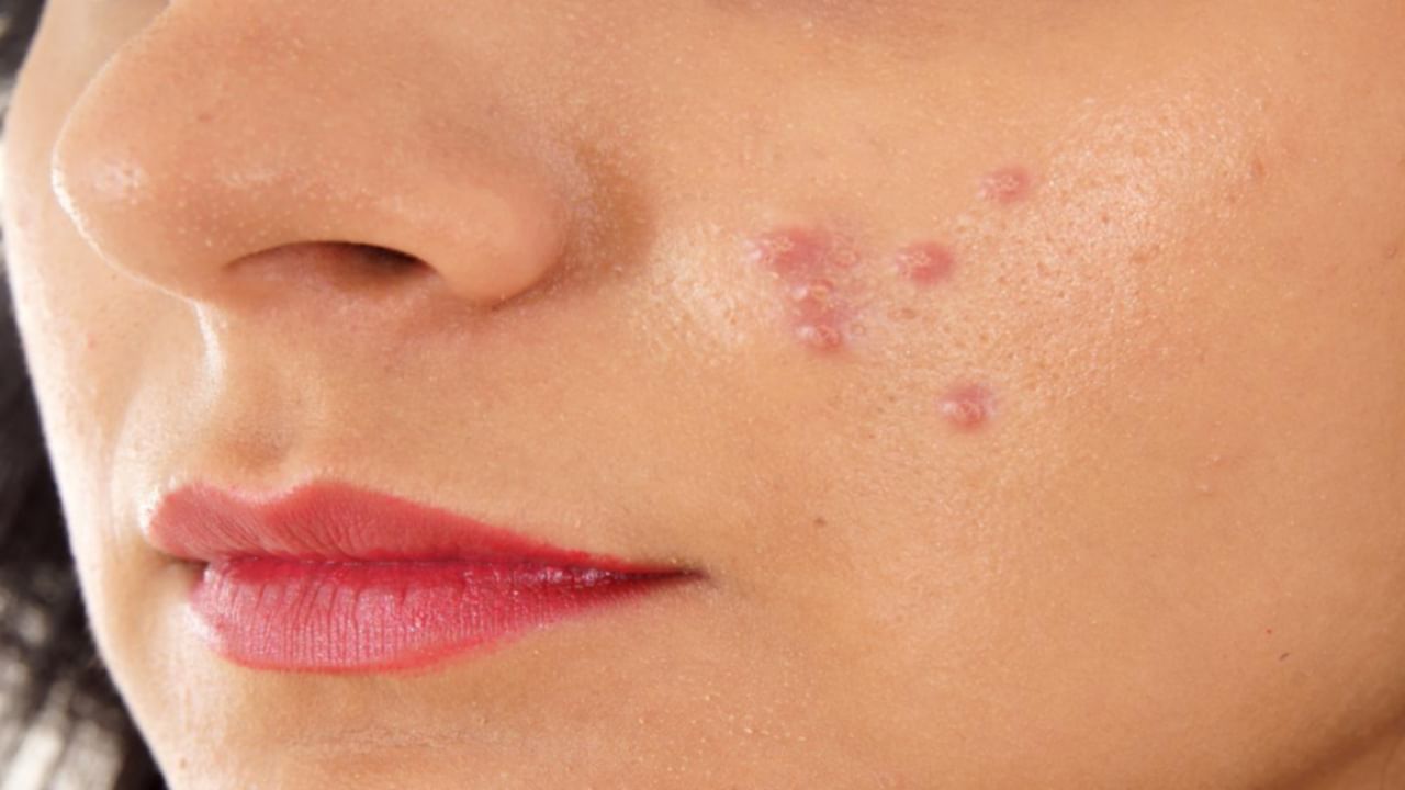 Acne Scars: మొటిమలతో ఇబ్బంది పడుతున్నారా.. మీరు వీటికి దూరంగా ఉండండి..