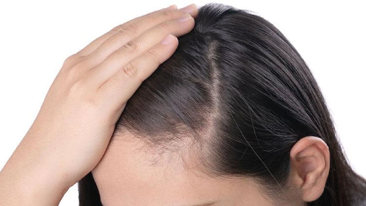 Baldness in Women: మహిళల్లో బట్టతల! అశ్రద్ధ చేస్తే అంతే! చికిత్సా విధానం కోసం వెంటనే క్లిక్ చేయండి..