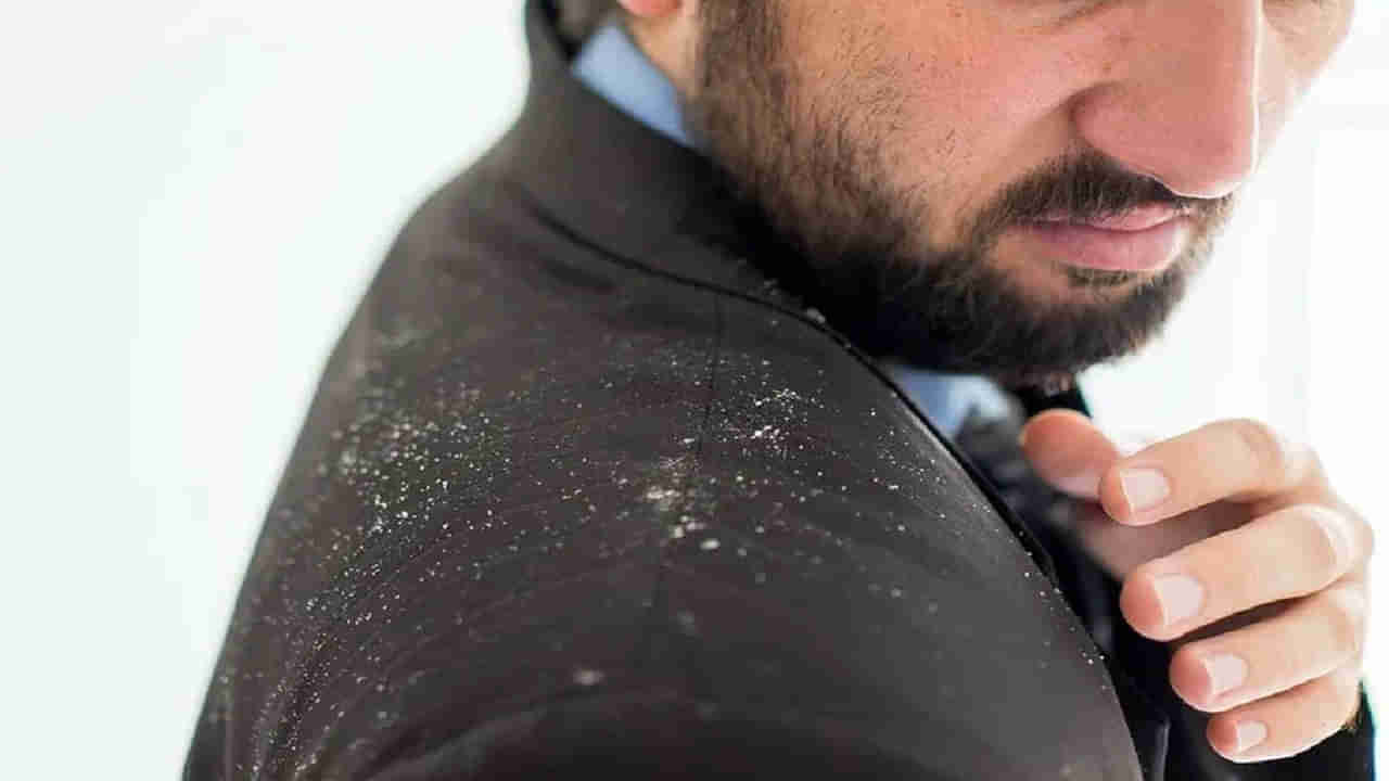 Dandruff: చుండ్రు సమస్య వేధిస్తుందా..? అయితే.. ఈ సింపుల్‌ టిప్స్‌తో ఇక పుల్‌స్టాప్‌ పెట్టేయండి..