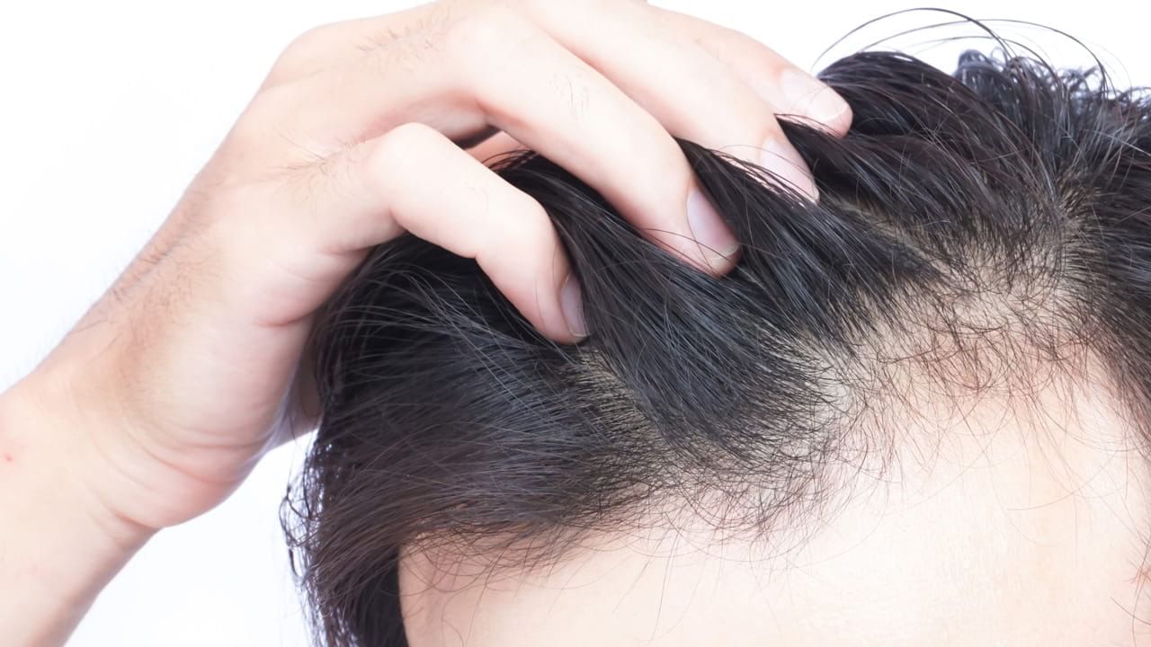 Hair Loss: జుట్టు రాలిపోతోంది.. మనోధైర్యం సన్నగిల్లుతోంది.. యువతలోనే ఈ పరిస్థితి మరింత అధికం..