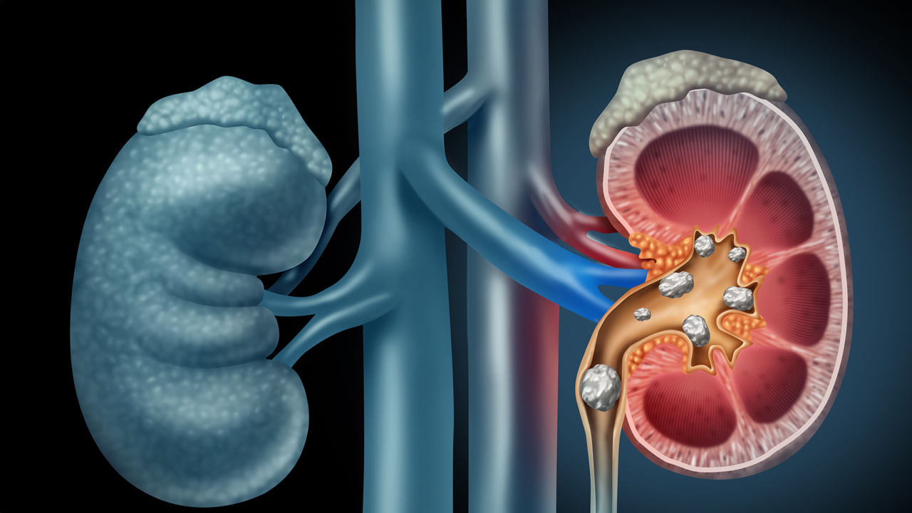 Kidney Stones: మీకు కిడ్నీల్లో రాళ్లు ఉన్నాయా..? జాగ్రత్త.. వీటికి దూరంగా ఉండటం ఉత్తమం