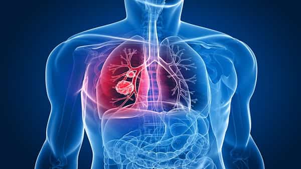 Lung Cancer: వామ్మో.. సిగరెట్ తాగకపోయినా లంగ్స్ క్యాన్సర్ వస్తుందట..! తాజా పరిశోధనలో సంచలన విషయాలు..