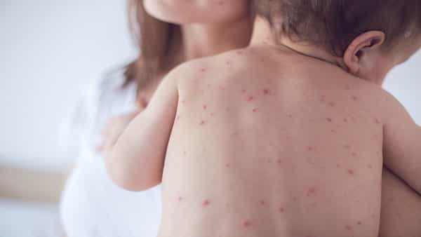 Measles: తట్టు మళ్లీ తరుముకొస్తోంది.. తస్మాత్ జాగ్రత్త..! ఇలాంటి లక్షణాలు కనిపిస్తే అస్సలు నిర్లక్ష్యం చేయకండి..