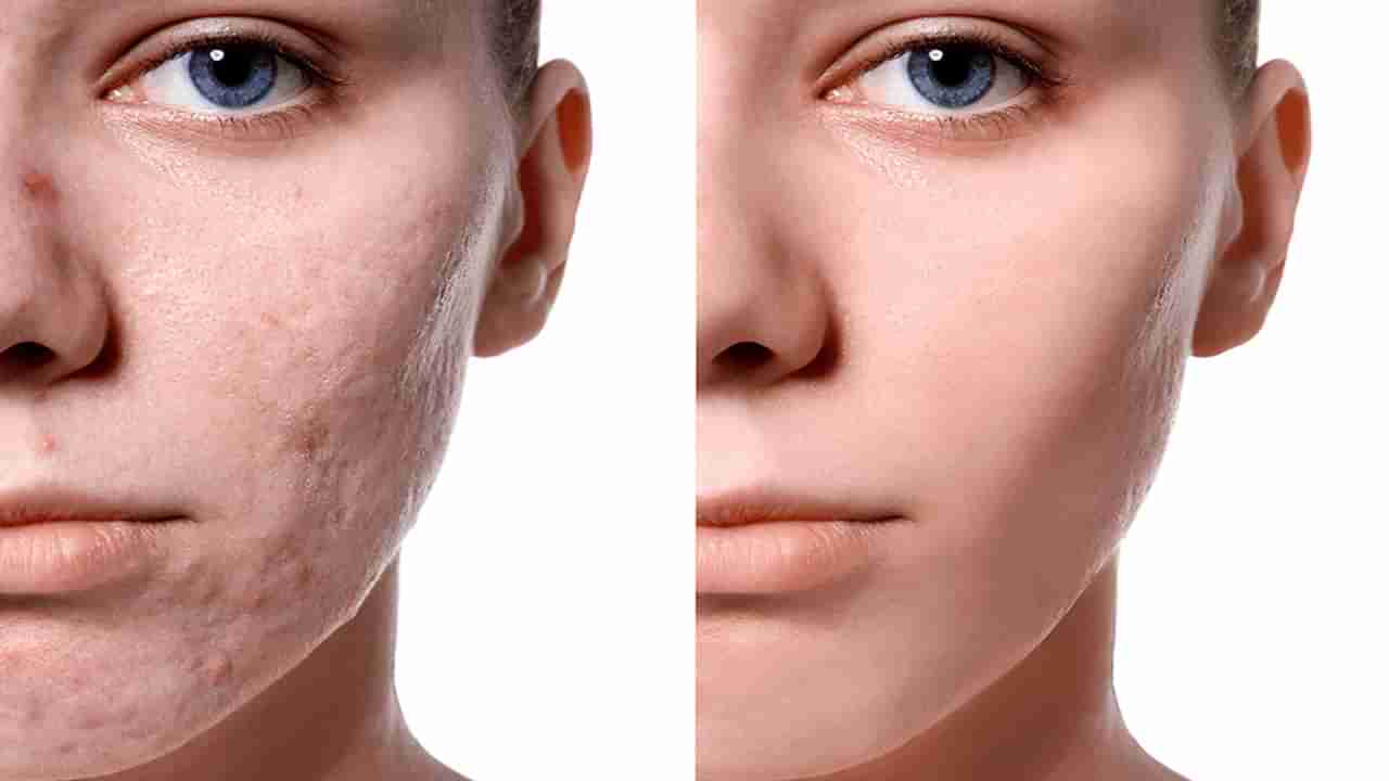 Pimple Marks Remedies: ఈ 6 ఇంటి చిట్కాలను పాటిస్తే.. మొటిమలు, మచ్చలు లేని ముఖారవిందం మీ సొంతం..