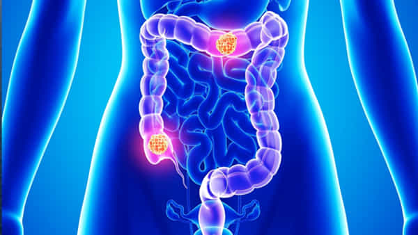 Colon Cancer: పెద్దపేగు క్యాన్సర్‌ లక్షణాలివే.. సకాలంలో గుర్తించకపోతే ప్రాణాంతకమే..!