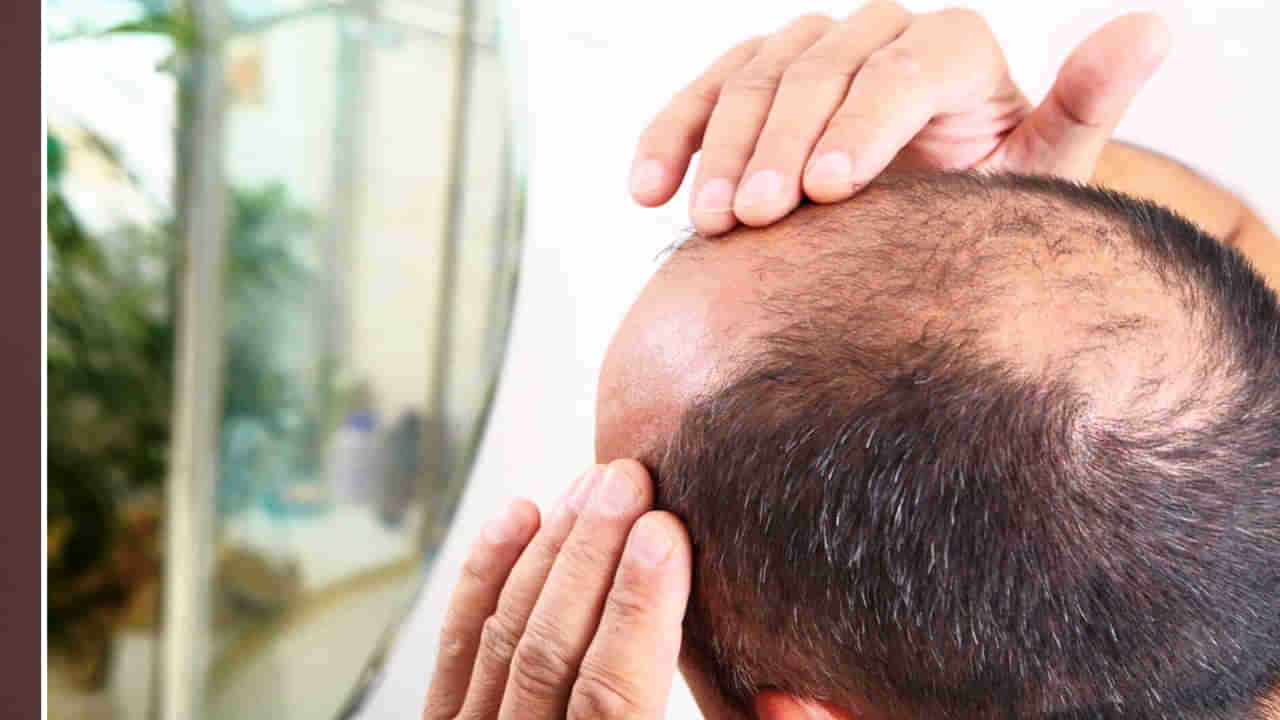 Baldness: బట్టతల ఉందని ఉద్యోగిని తొలిగించారు.. ఆ తర్వాత ఏం జరిగిందో తెలిస్తే షాకవుతారు..