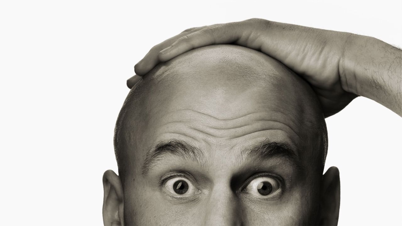 Baldness: అబ్బాయిలూ వింటున్నారా? ఈ తప్పులు చేశారంటే చిన్న వయసులోనే బట్టతల ఖాయం..