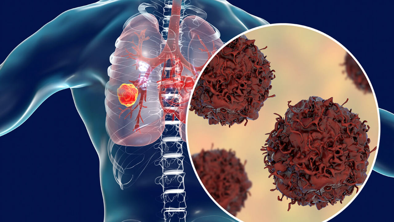 Lung Cancer: ఊపిరితిత్తుల కేన్సర్‌ లక్షణాలివే.. మీలో ఇవి కనిపిస్తే అసలు నిర్లక్ష్యం చేయకండి..