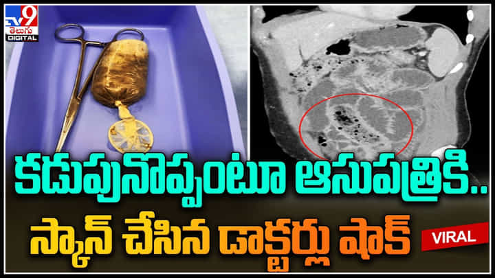Condom: కడుపులో కనిపించిన కండోమ్..! కడుపునొప్పితో ఆస్పత్రికి వెళ్లిన వ్యక్తి రిపోర్ట్ చూసి వైద్యులు షాక్. Condom: కడుపులో కనిపించిన కండోమ్..! కడుపునొప్పితో ఆస్పత్రికి వెళ్లిన వ్యక్తి రిపోర్ట్ చూసి వైద్యులు షాక్.