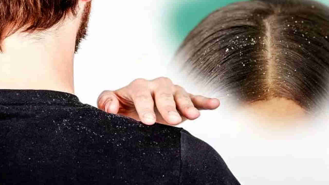 Dandruff Tips: తలలో చుండ్రుకు ప్రధాన కారణాలివే.. వీటిని నిరోధిస్తే మీ ప్రోబ్లెమ్ సాల్వ్ అయినట్లే..!