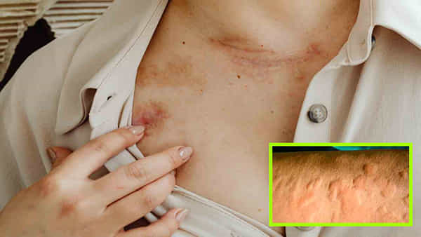 Skin Allergy Tips: దురద, దద్దుర్లతో బాధపడుతున్నారా..? ఈ పదార్థాలను వాడారంటే సమస్యకు చెక్ పెట్టినట్లే..!