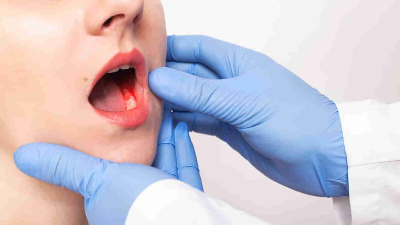 Mouth Cancer: మీలో ఈ లక్షణాలు కనిపిస్తున్నాయా..? నోటి క్యాన్సర్‌ కావచ్చు.. జాగ్రత్త