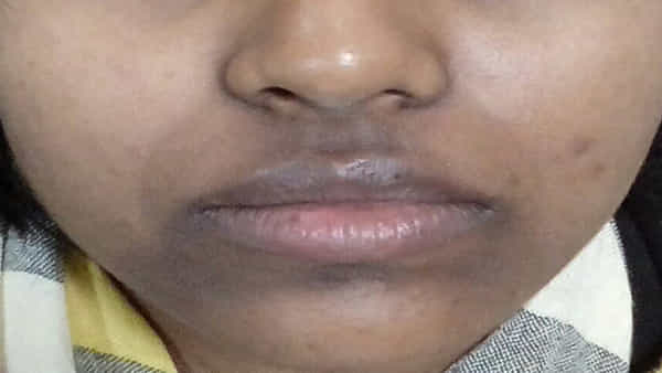 Skin Care Tips: నోటి చుట్టూ చర్మం నల్లగా మారిందా..? ఈ చిట్కాలను పాటించండి.. మీ ముఖం హీరోయిన్లా మారిపోతుంది..!