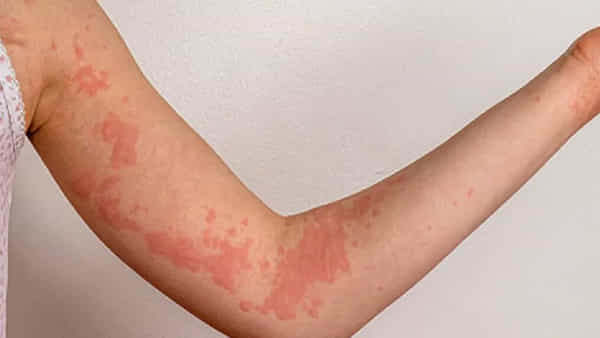 Health Tips: వ్యాయామం తరువాత తీవ్రమైన దురదగా ఉందా? ఏమాత్రం నిర్లక్ష్యం చేయకుండా ఇలా చేయండి..