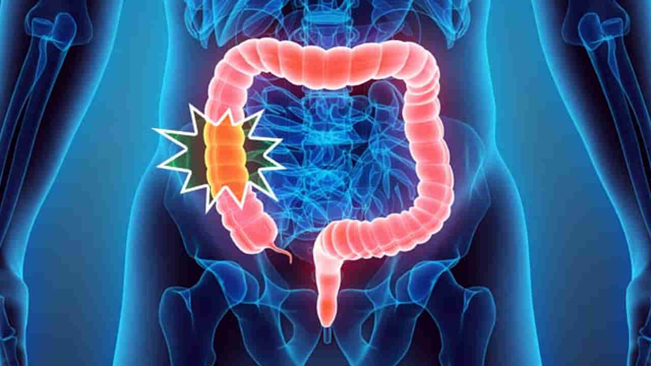 Colorectal Cancer:పెద్దపేగు క్యాన్సర్‌ లక్షణాలివే.. ఆ వ్యక్తులకే ఈ రిస్క్ ఎక్కువ..!