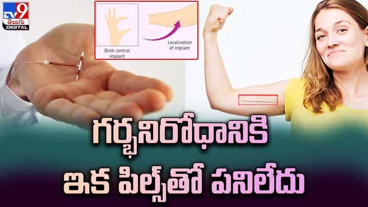 గర్భనిరోధానికి ఇక పిల్స్తో పనిలేదు.. ఈ కొత్త సాధనం వచ్చేసిందిగా గర్భనిరోధానికి ఇక పిల్స్తో పనిలేదు.. ఈ కొత్త సాధనం వచ్చేసిందిగా