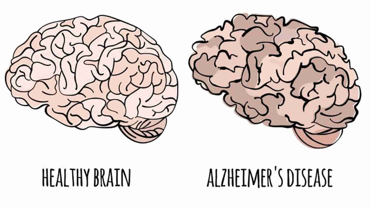 Memory Power: అల్జీమర్స్ లక్షణాలివే.. కనిపిస్తే వెంటనే వైద్యుడిని సంప్రదించండి.. లేదంటే కష్టాలు తప్పవు..