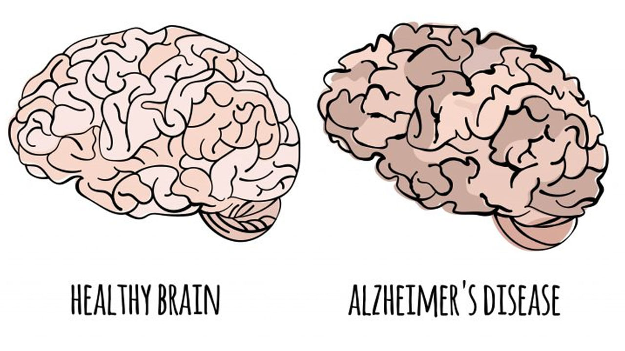 Memory Power: అల్జీమర్స్ లక్షణాలివే.. కనిపిస్తే వెంటనే వైద్యుడిని సంప్రదించండి.. లేదంటే కష్టాలు తప్పవు..