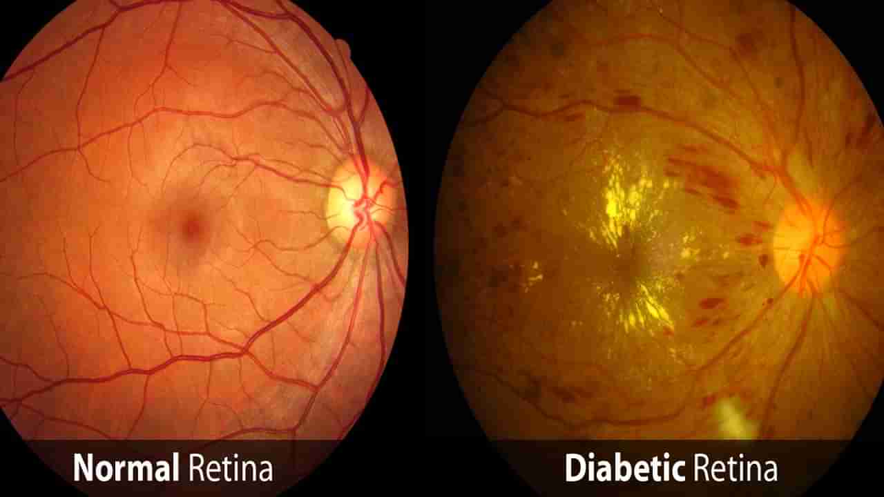 Diabetic Retinopathy: షుగర్ వ్యాధిగ్రస్తులకు కంటి సమస్యలు ఎందుకు వస్తాయో? తెలిస్తే షాకవుతారు