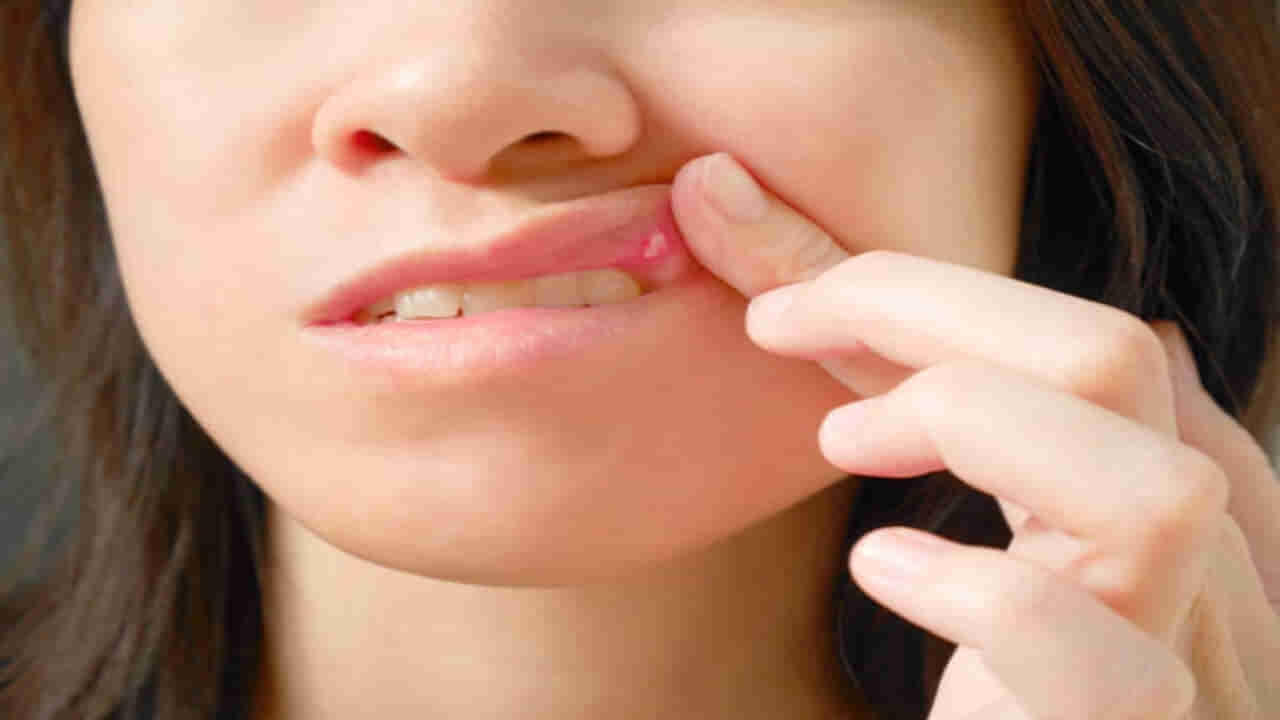 Mouth Ulcers: నోటి అల్సర్లు ఇబ్బంది పెడుతున్నాయా..? ఇంటి నివారణలతో చెక్ పెట్టొచ్చు..