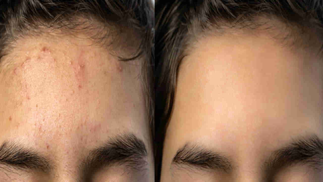 Pimples: ఈ పేస్ట్ రాసుకుంటే ముఖంపై మొటిమలు, మచ్చలు, గుంతలు మటుమాయం