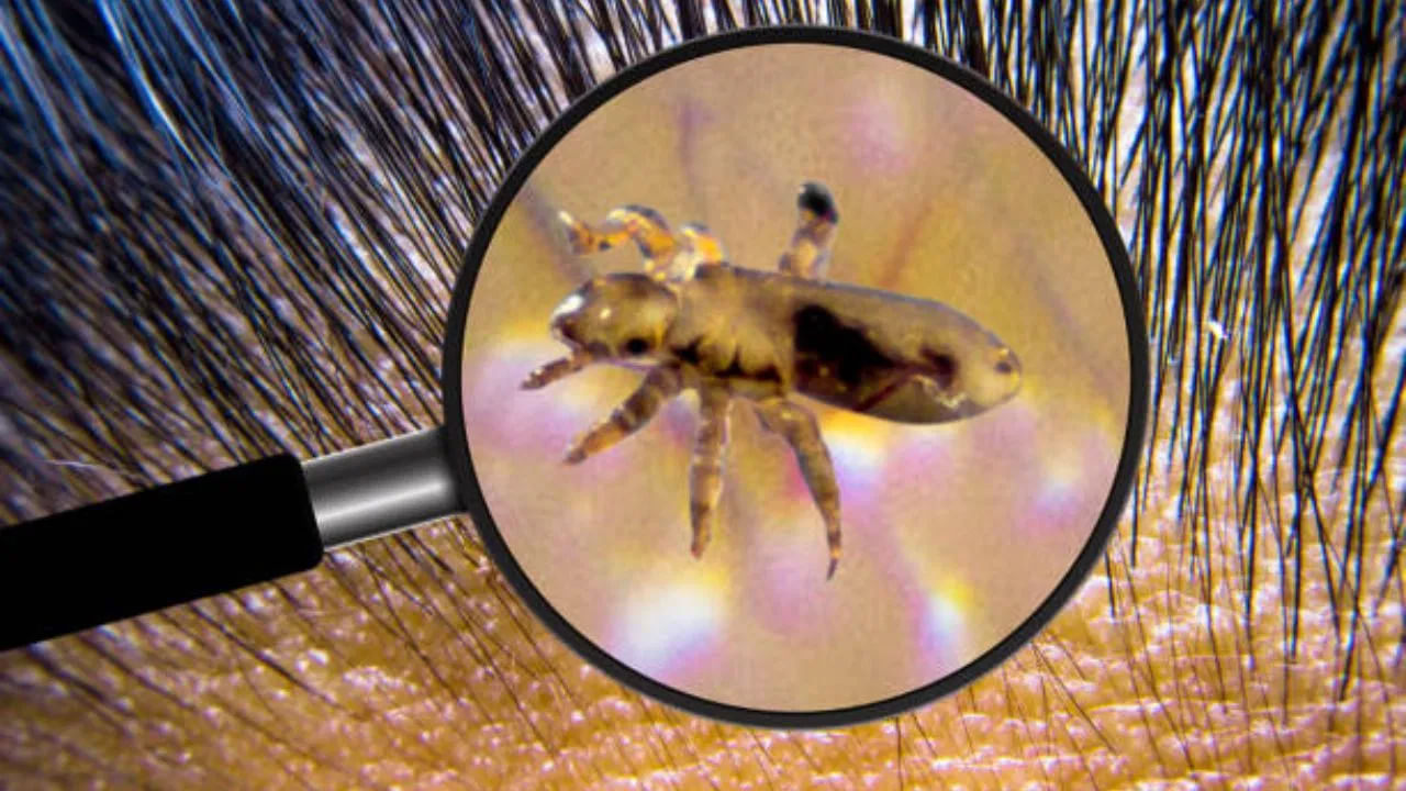 Rid of Lice: తలలో పేళ్లు అస్సలు పోవడం లేదా? ఈ 5 చిట్కాలతో దెబ్బకు పరార్ అవ్వాల్సిందే..